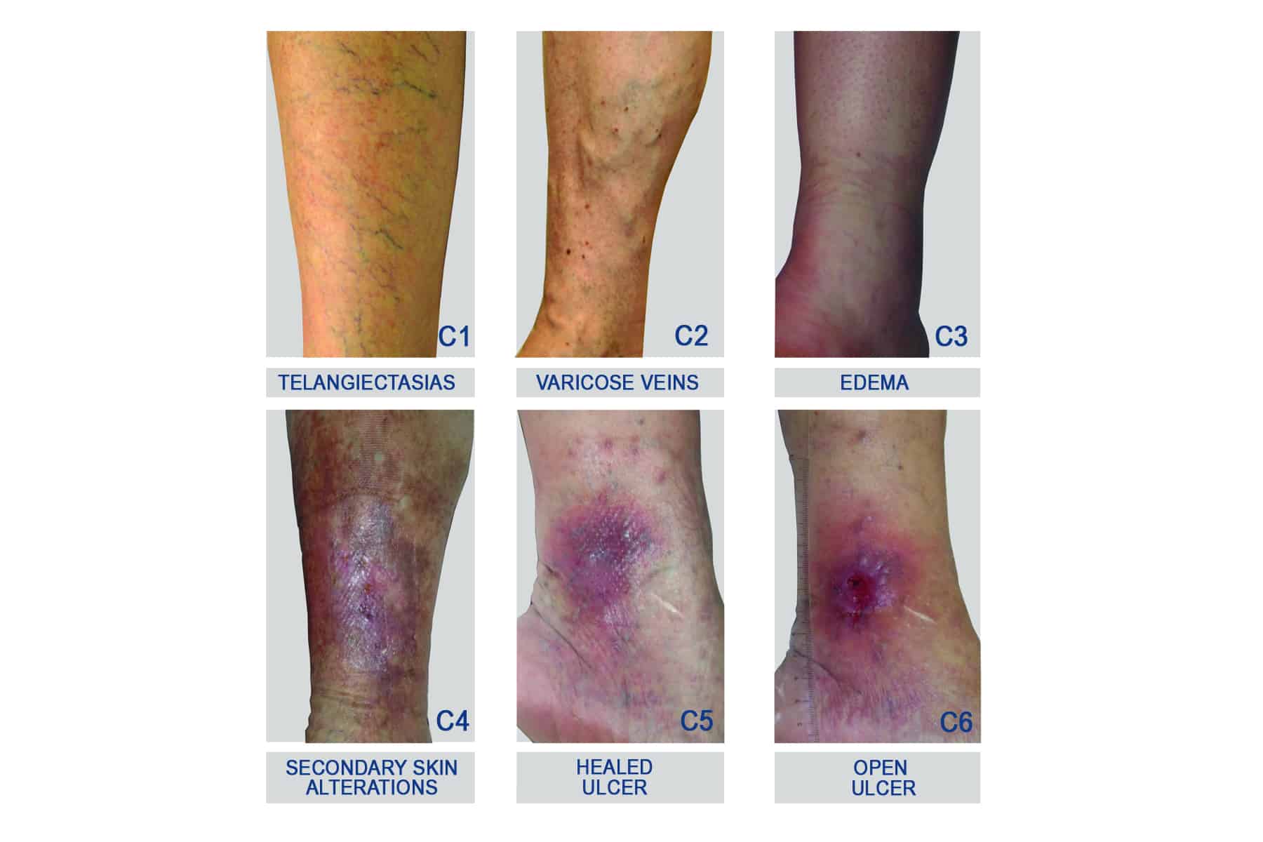 Clearing the Web of Spider Veins: Z-ROC Dermatology: Cosmetic