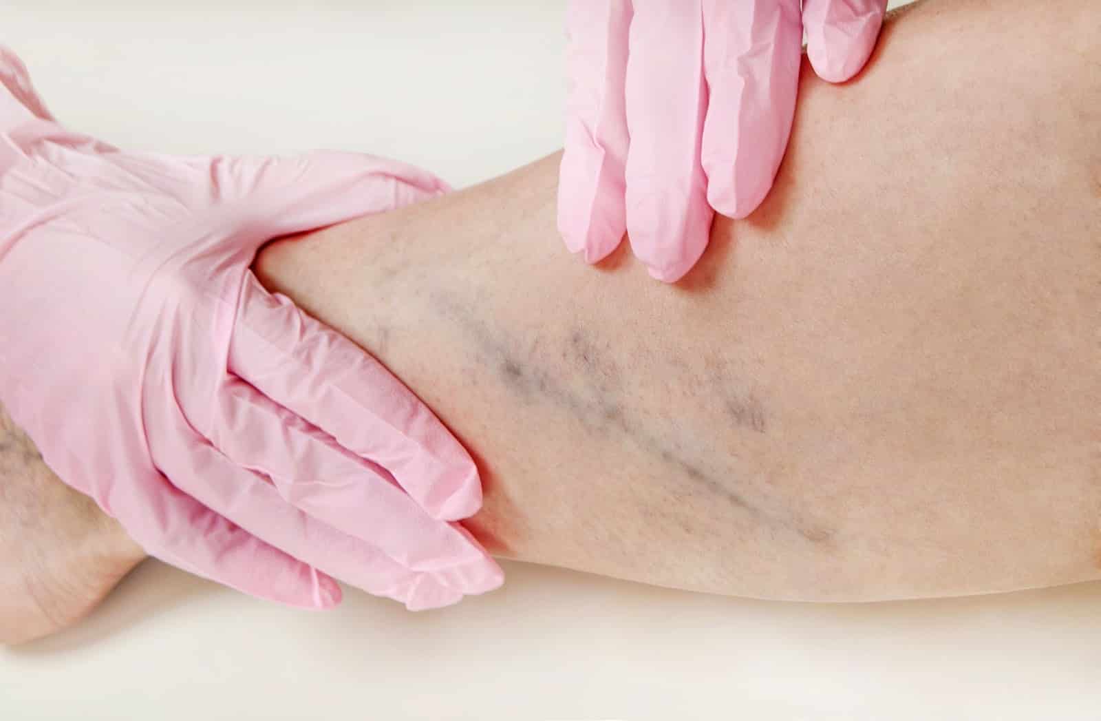 Sclerotherapy Procedure