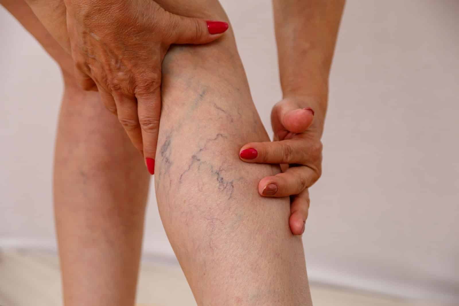 woman with hands on legs with varicose veins