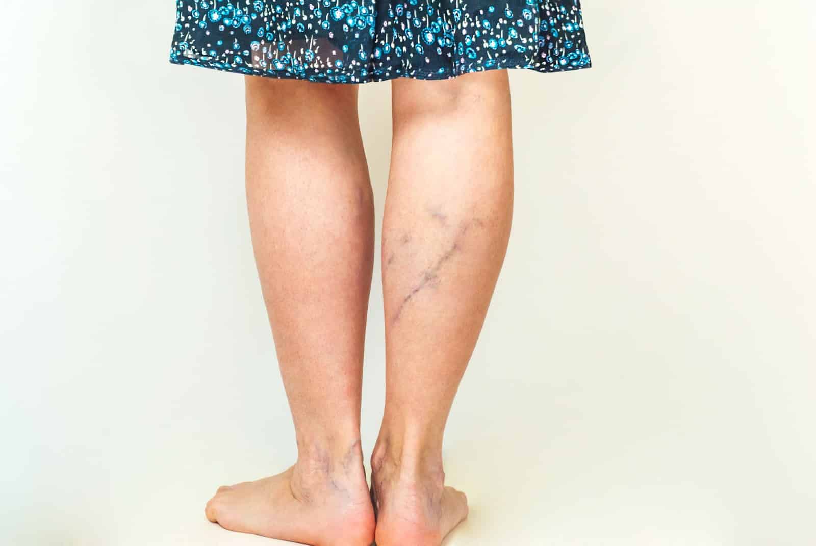 woman with varicose veins behind her legs