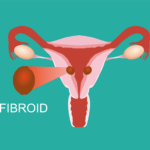 Fibroids Heavy Bleeding And Other Symptoms That Indicate Uterine Fibroids