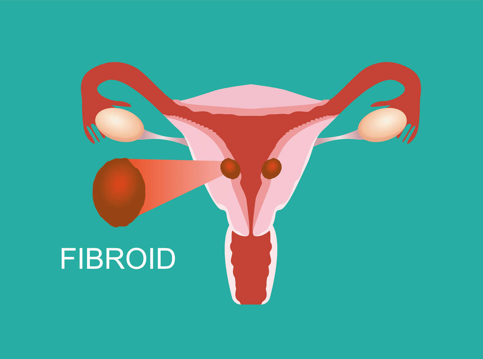 fibroids heavy bleeding diagram