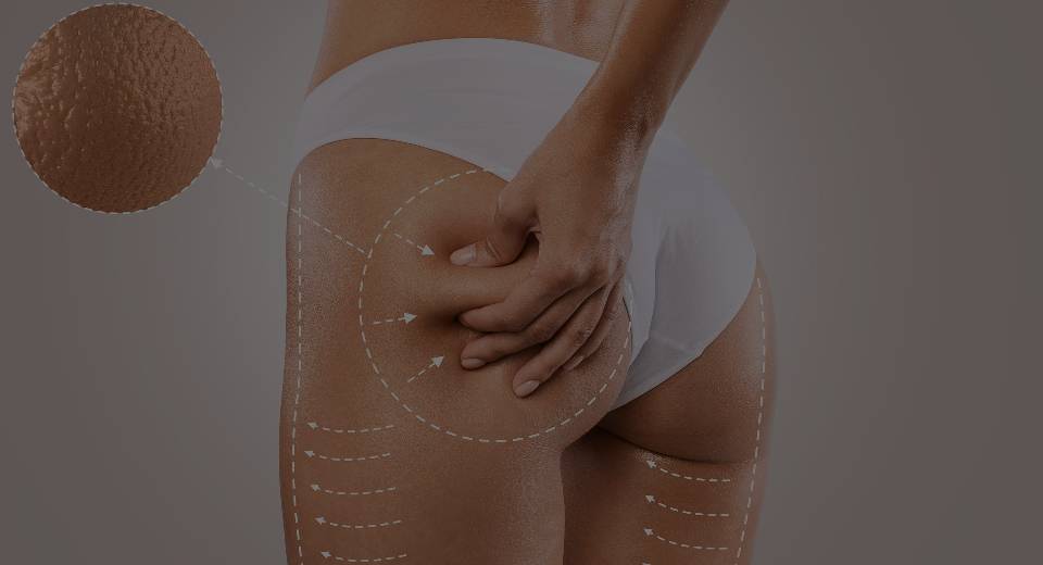A woman in white clothing, showcasing the results after her Cellulite Service (BTL CELLUTONE™) at Mark Medical Care, while holding her leg to emphasize the improvement.