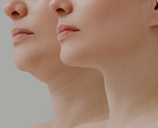 Before and after double chin reduction showcasing two women's faces - Mark Medical Care