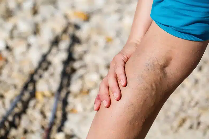 a person with varicose veins on leg