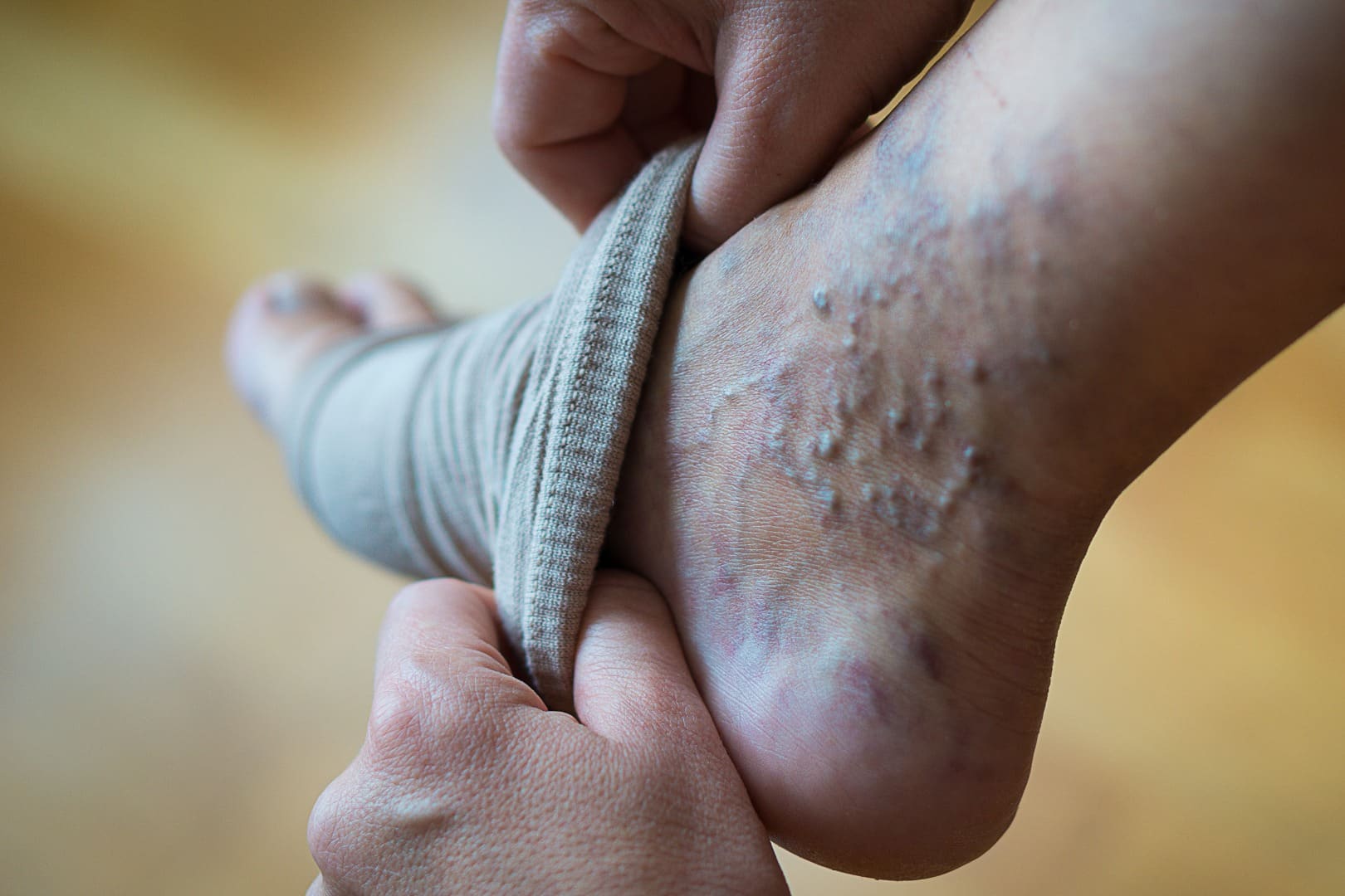 A person's foot with severe Varicose Veins - Mark Medical Care